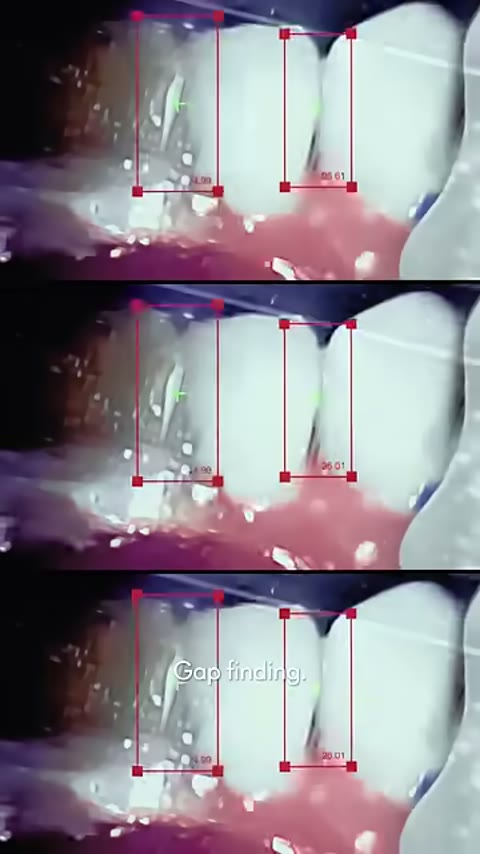 Beat 5: Tooth scanning